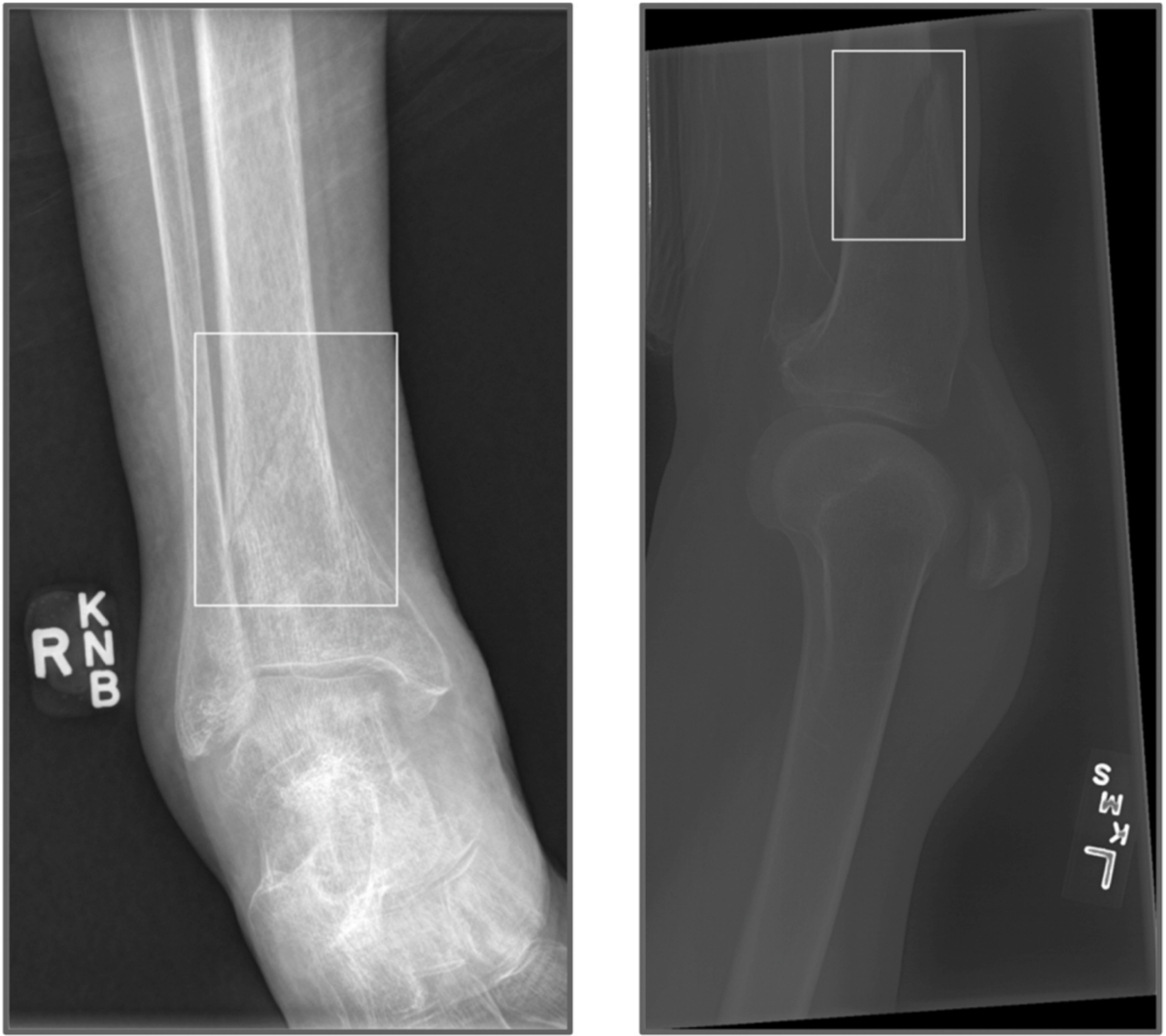 radiographie de traumatisme assistée par IA