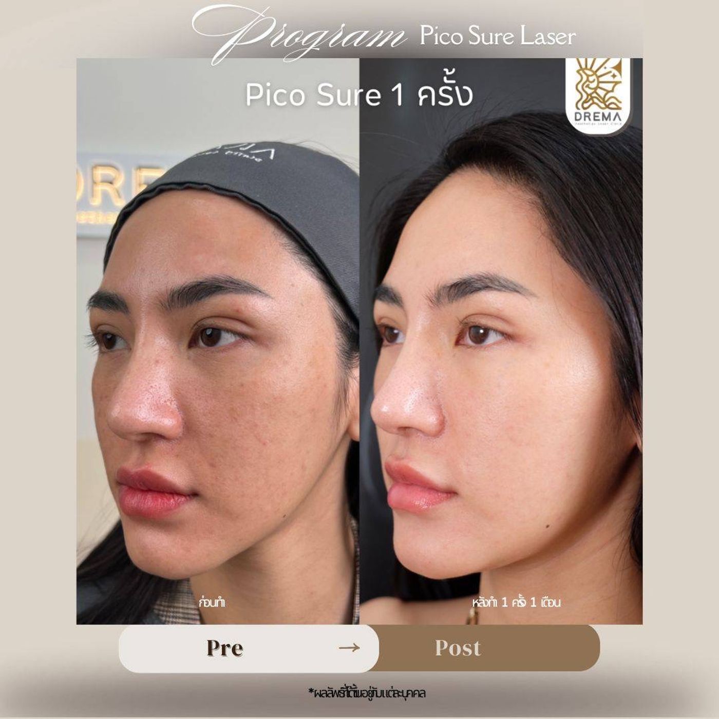 รูปรีวิว Pico Drema Clinic เคสที่ 3