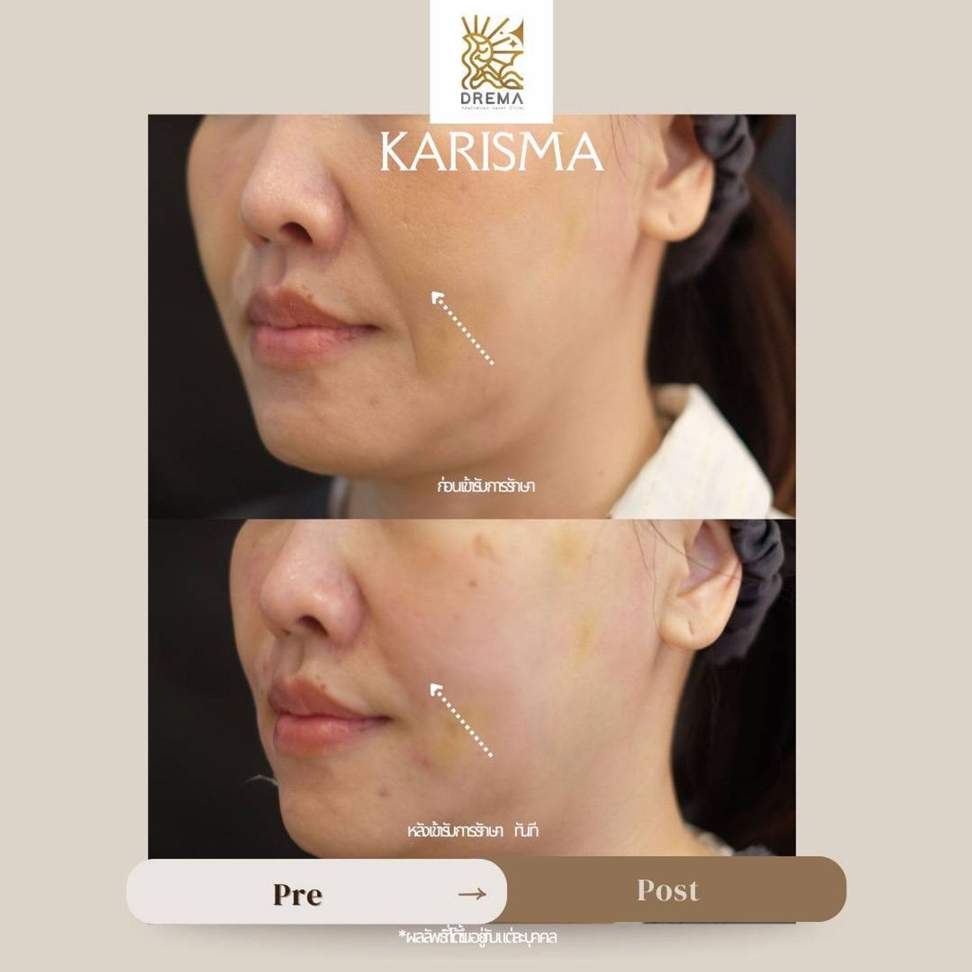 รูปรีวิว Skin Booster Drema Clinic เคสที่ 8