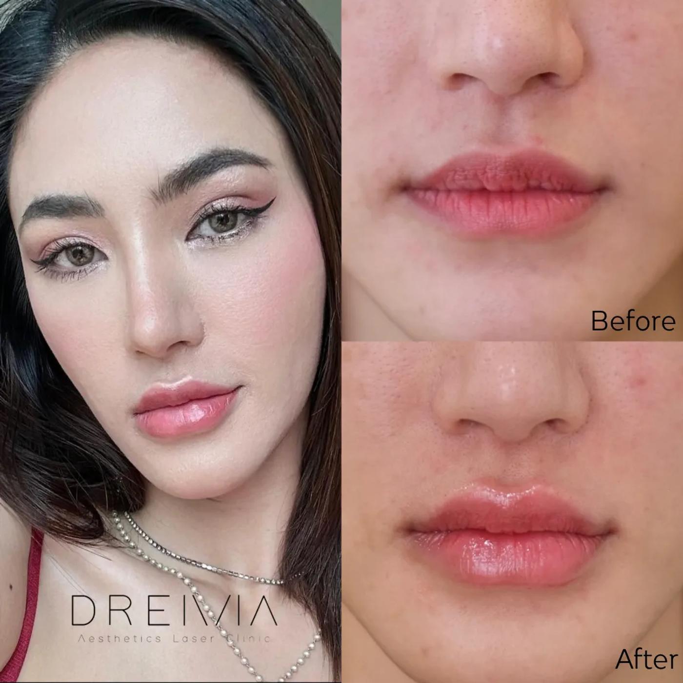 รีวิว Filler ปาก 42