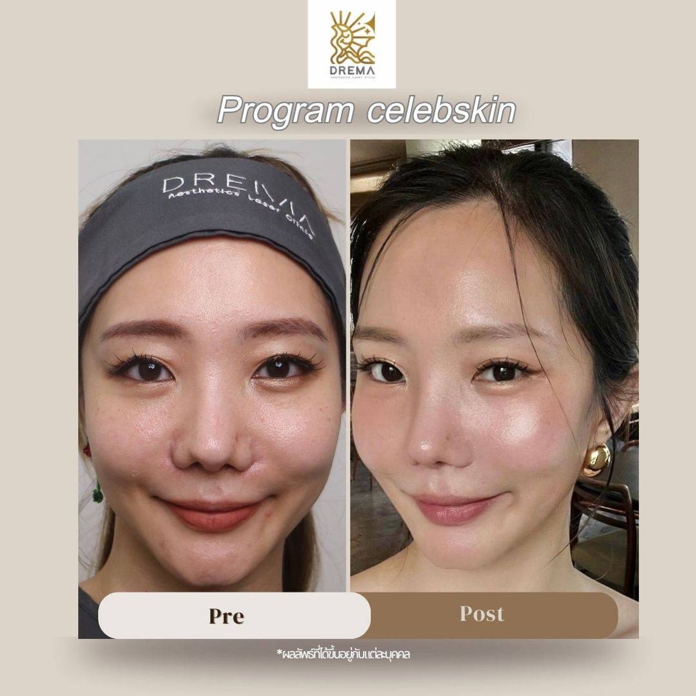 รูปรีวิว Skin Booster Drema Clinic เคสที่ 4