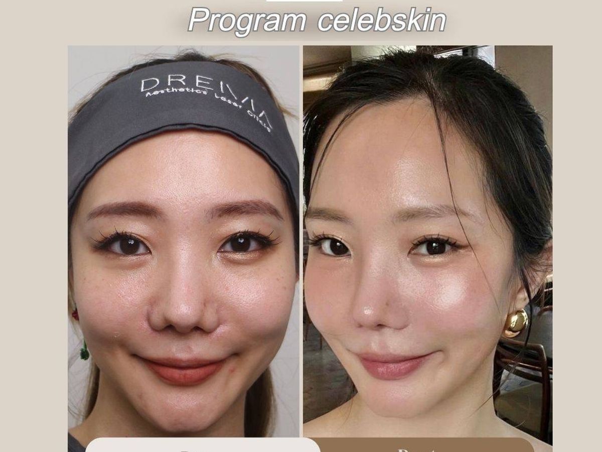 รีวิว Skin Booster Drema Clinic