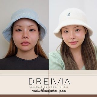 รีวิว Filler ปาก 48