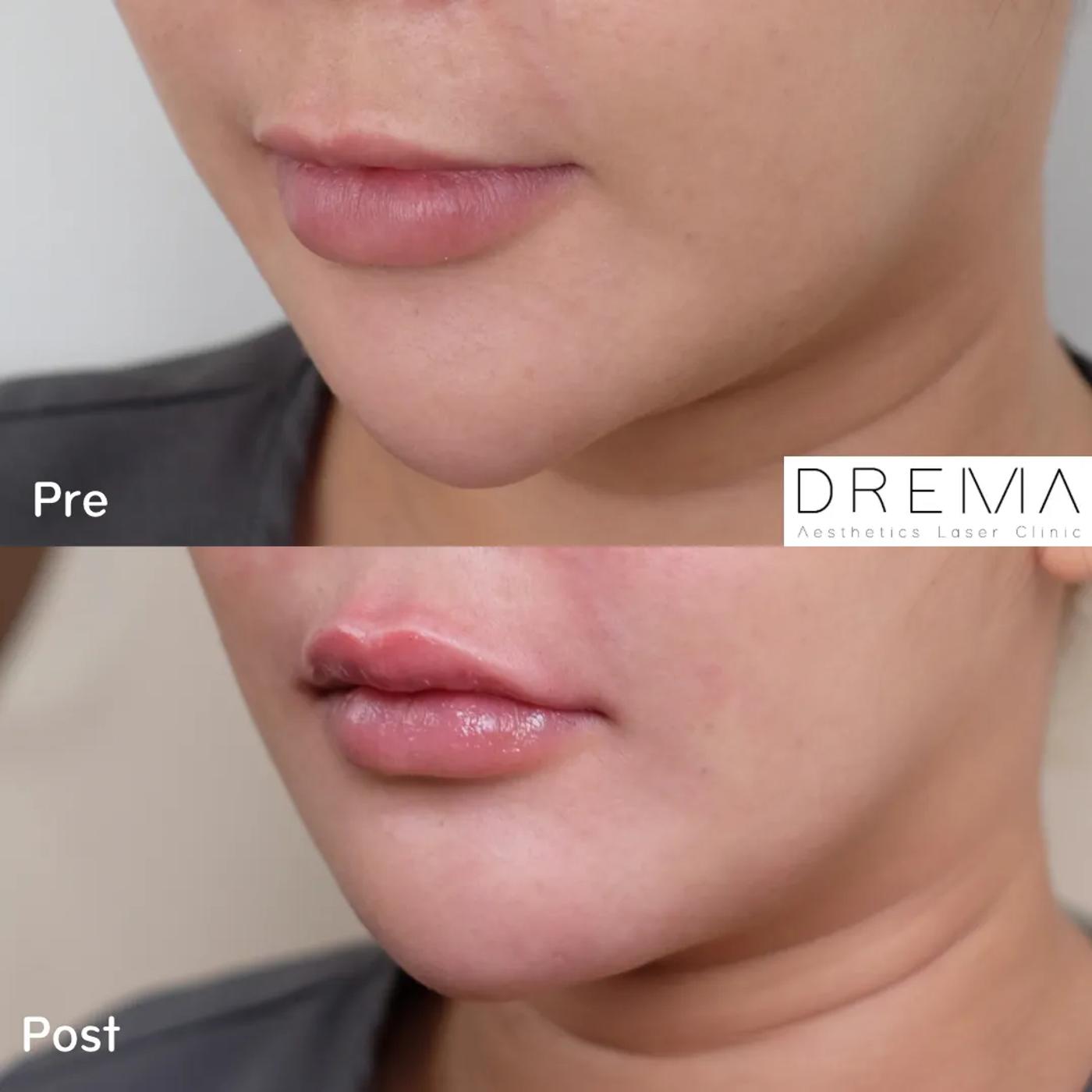 รีวิว Filler ปาก 1