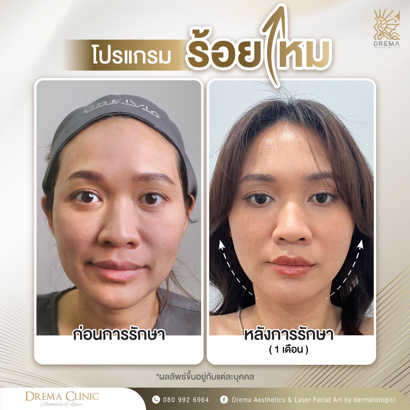 รูปรีวิว ร้อยไหม Drema Clinic เคสที่ 17