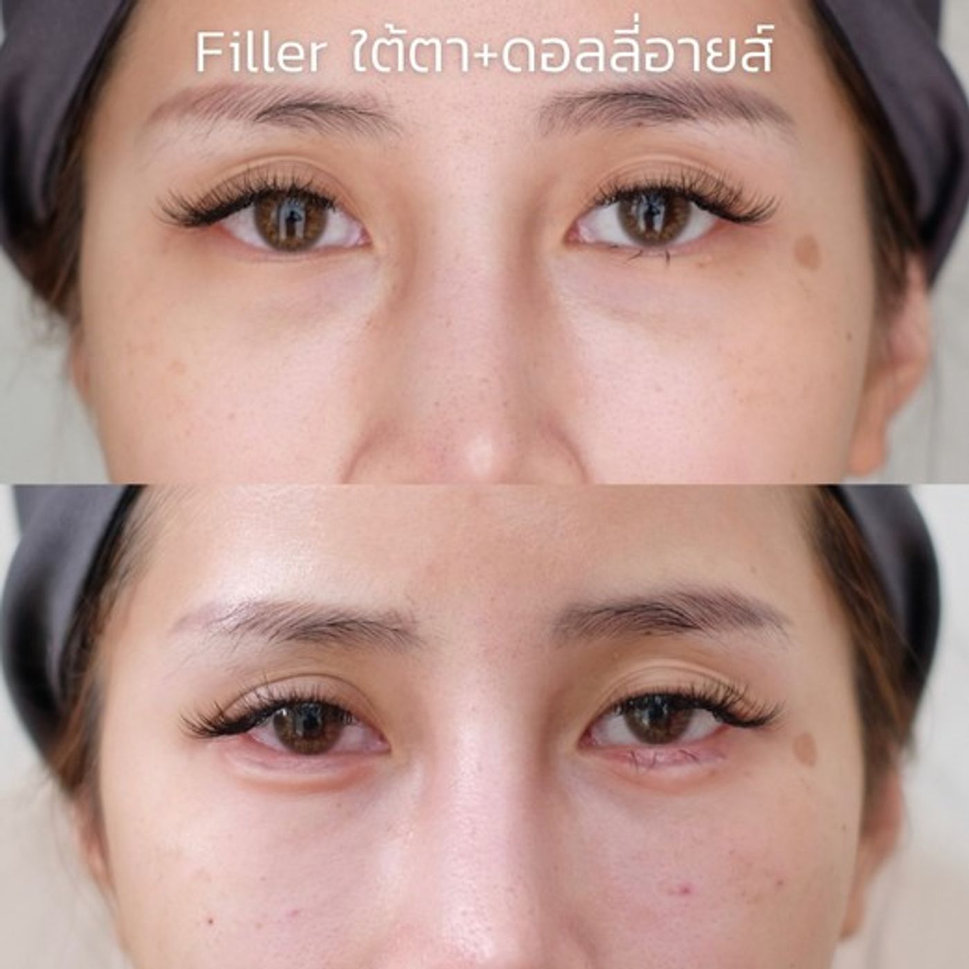 รีวิวฟิลเลอร์ใต้ตา 19