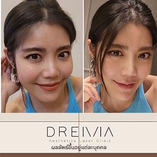 รีวิว Filler ปาก 45