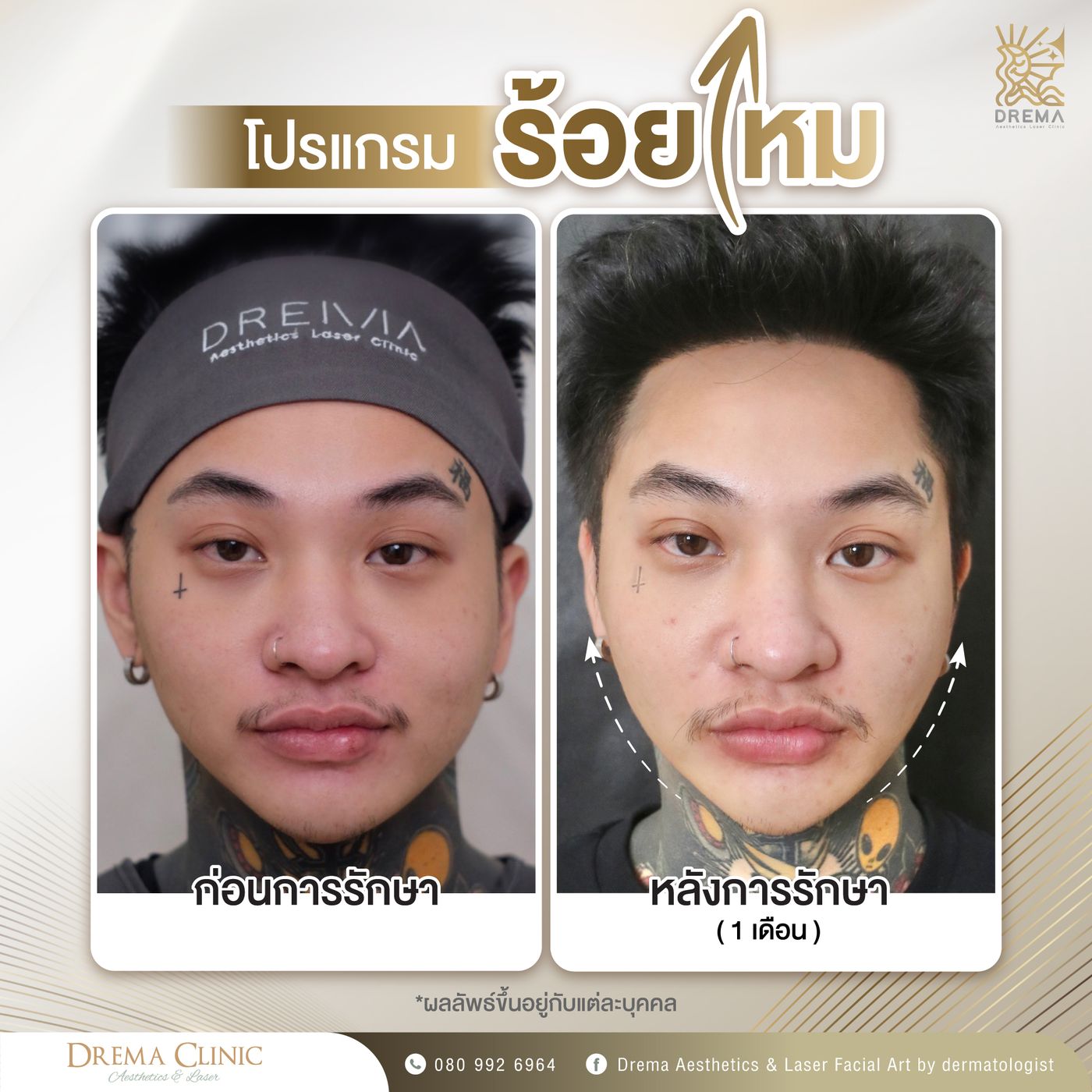 รูปรีวิว ร้อยไหม Drema Clinic เคสที่ 15