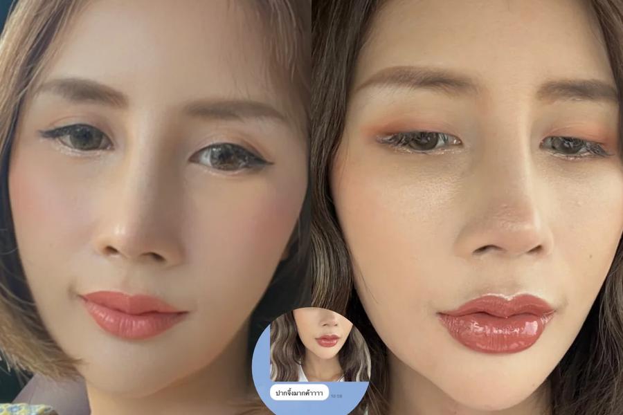หลังฉีดฟิลเลอร์บวมกี่วัน
