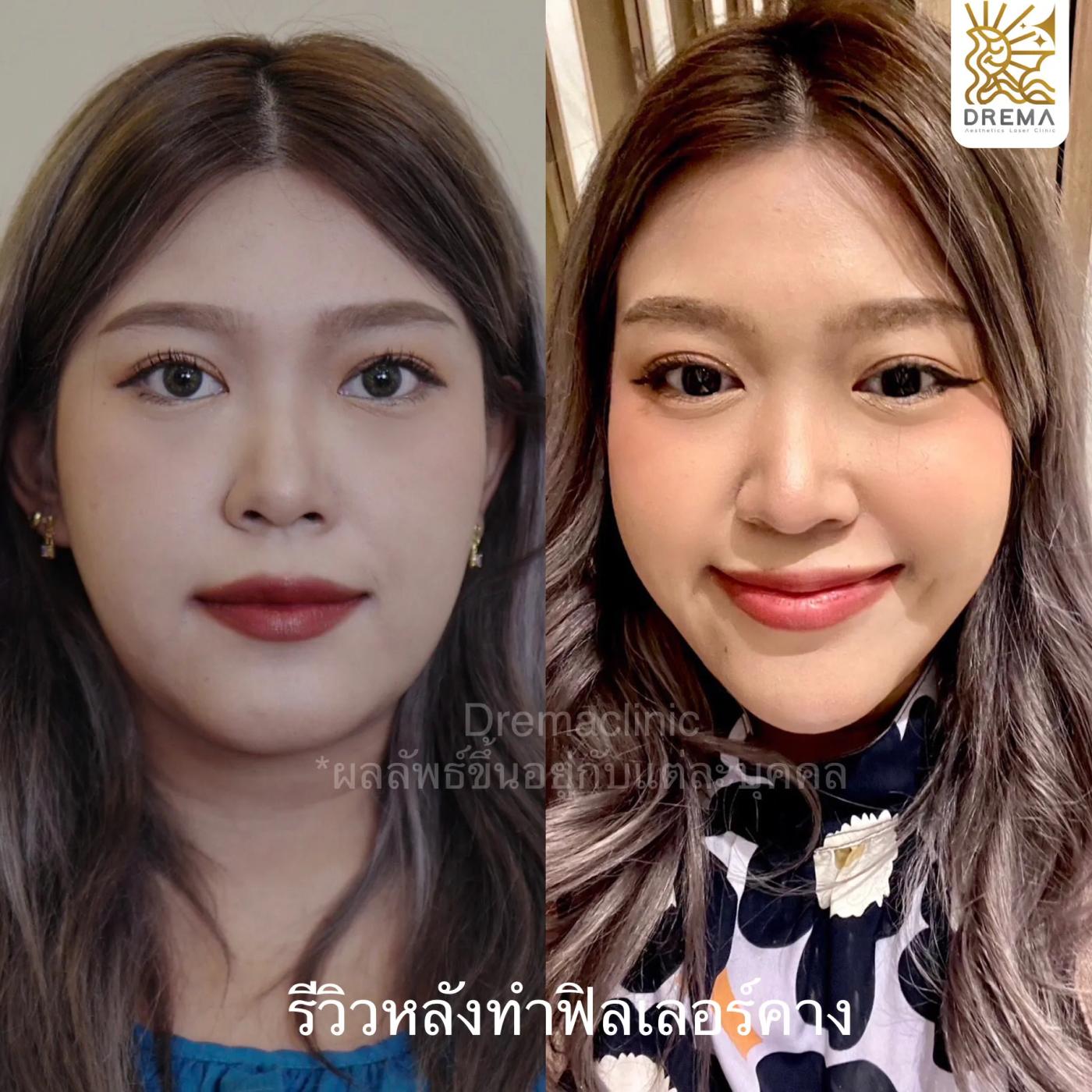 รีวิว ฟิลเลอร์คาง 3