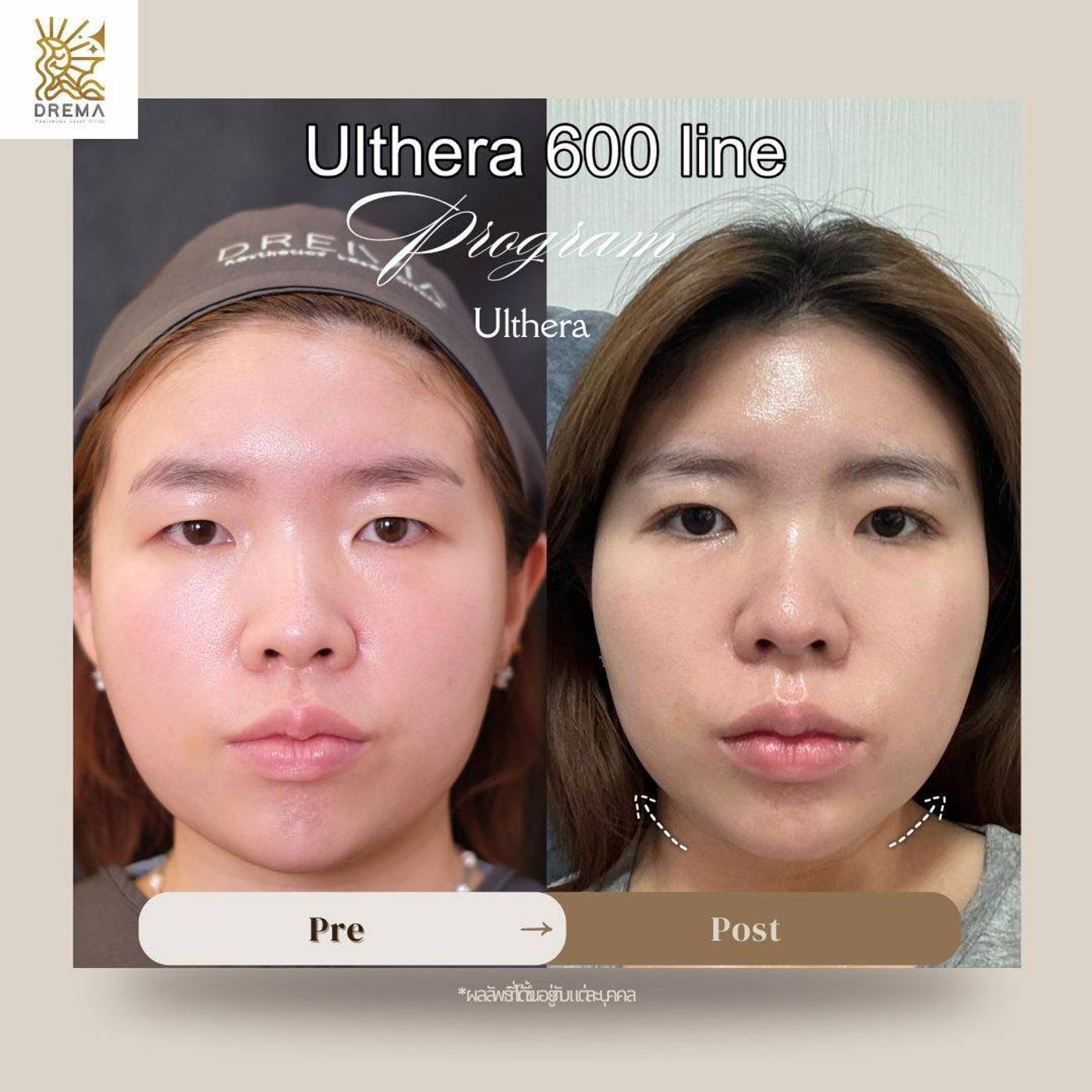 รูปรีวิว Ulthera Drema Clinic เคสที่ 3