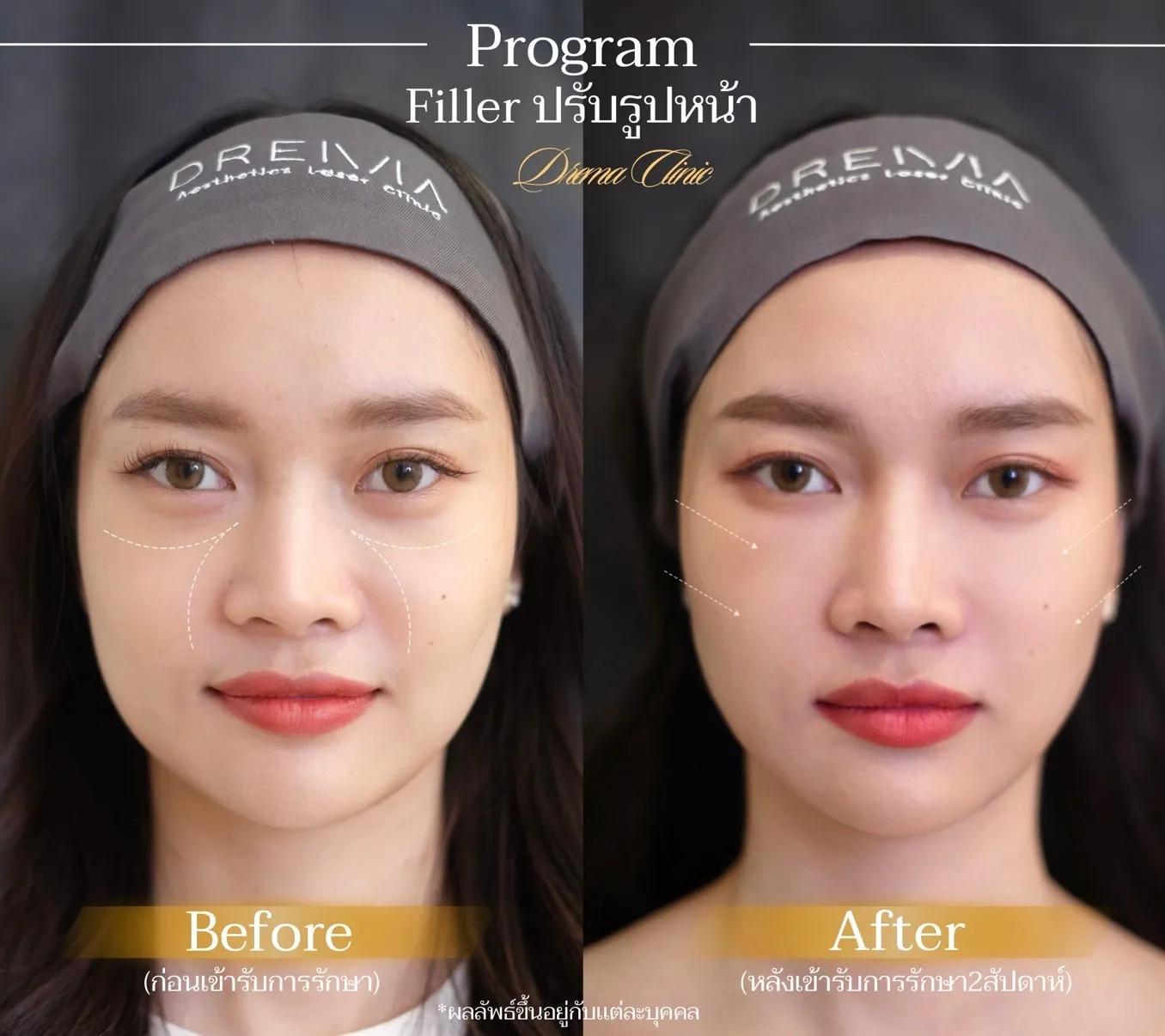 รีวิวการปรับรูปหน้า 19