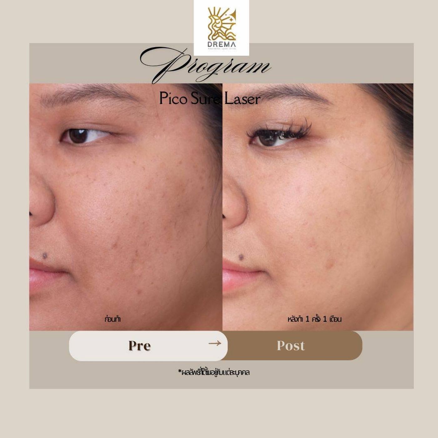 รูปรีวิว Pico Drema Clinic เคสที่ 23