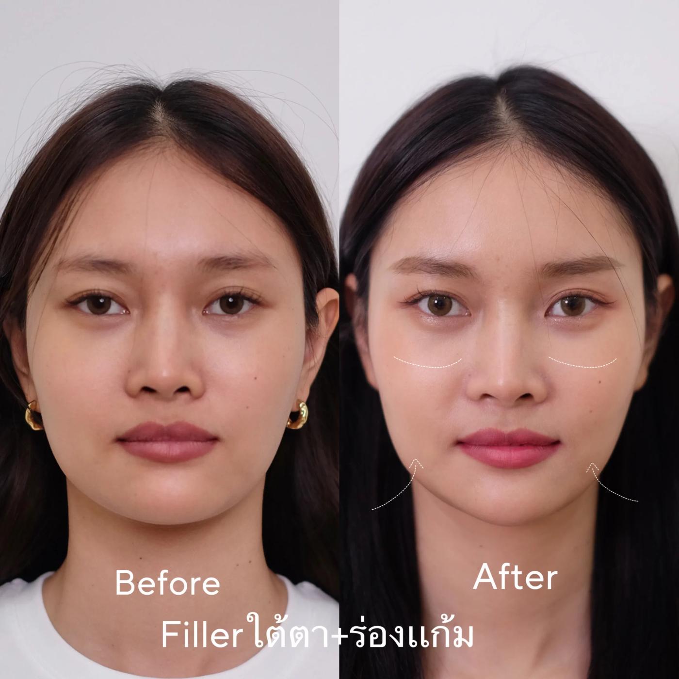 รีวิวฟิลเลอร์ใต้ตา 1