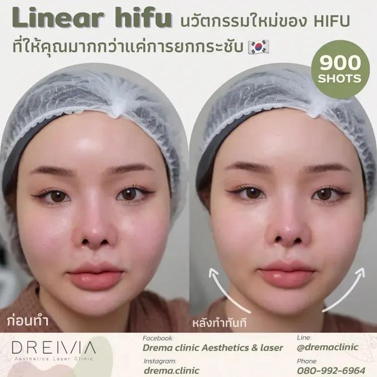 รีวิว LIFU