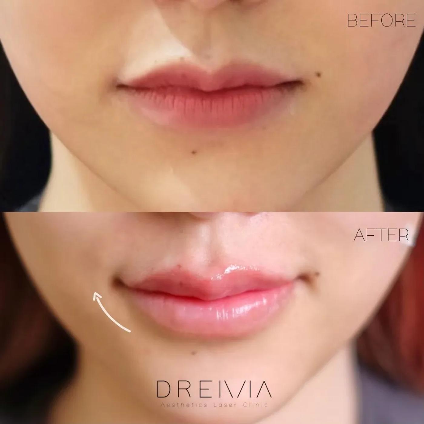 รีวิว Filler ปาก 39