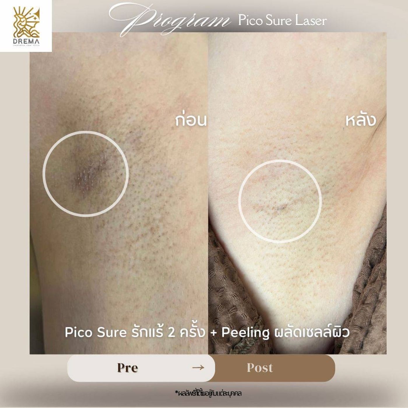 รูปรีวิว Pico Drema Clinic เคสที่ 28