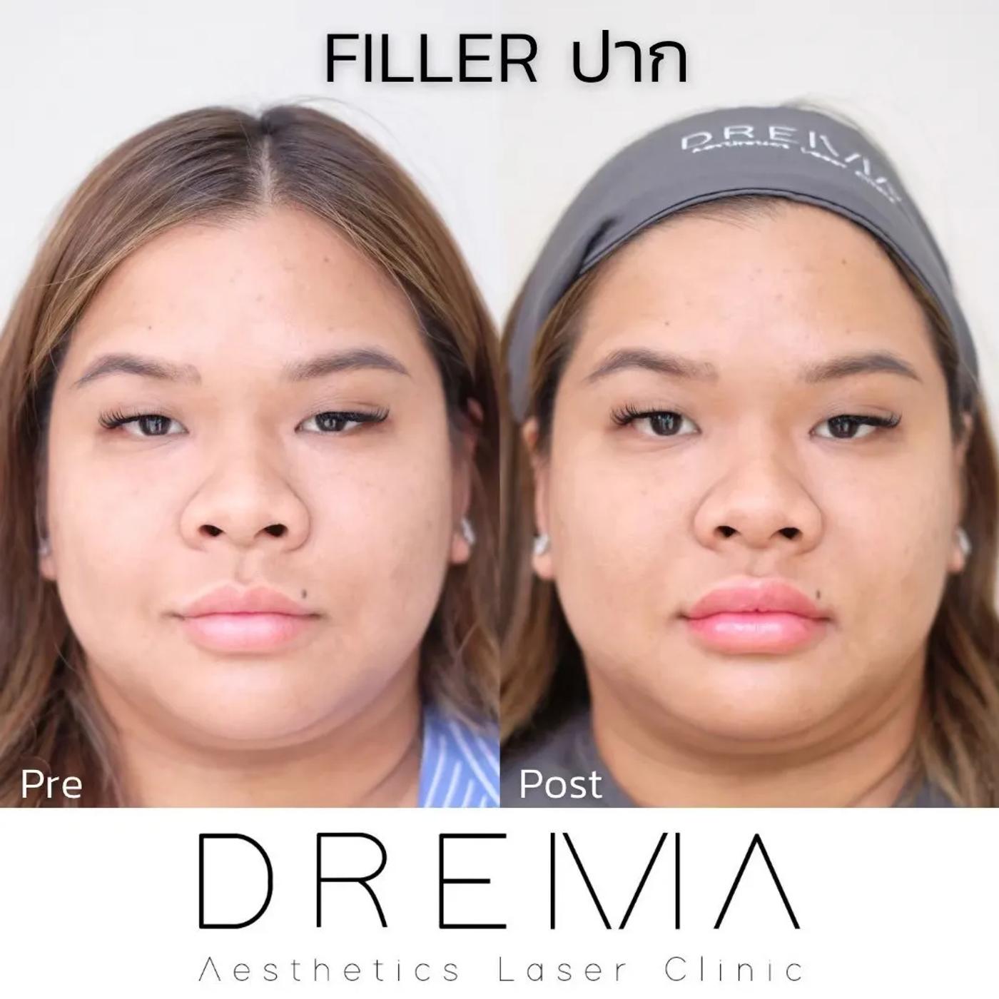 รีวิว Filler ปาก 43