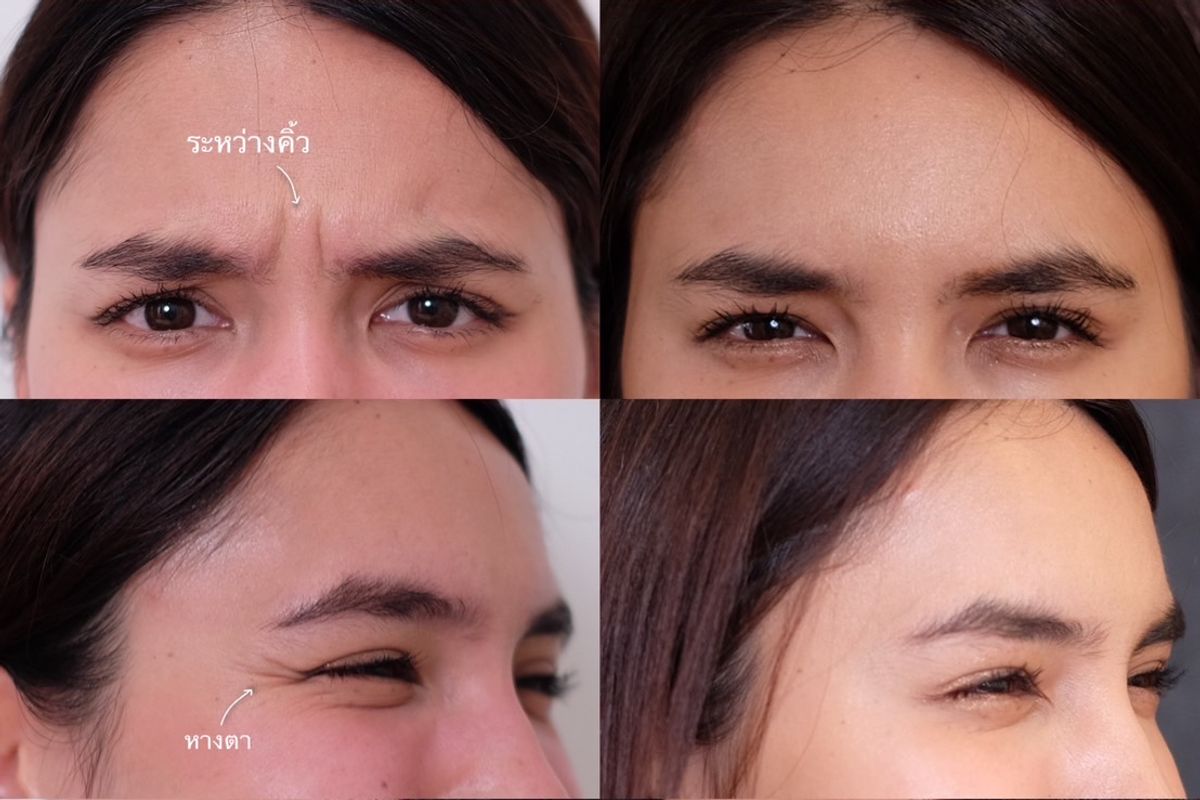 ภาพริ้วรอย