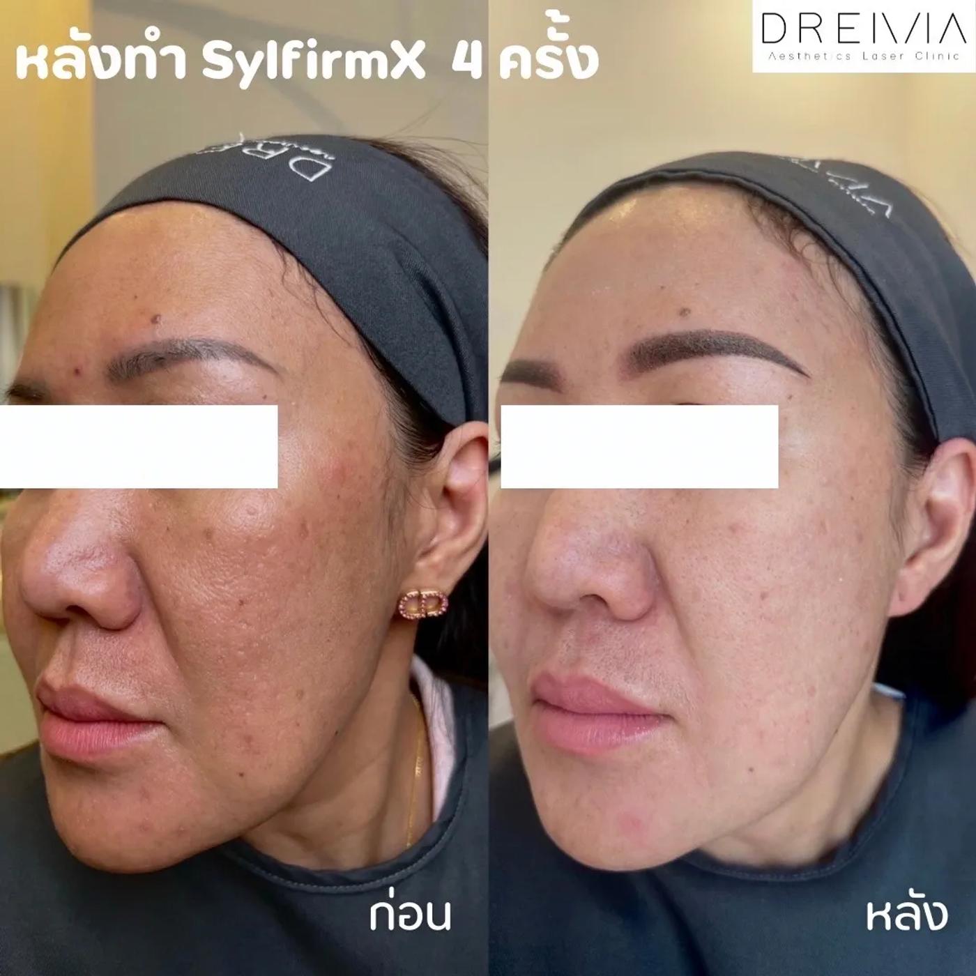 รีวิว SYLFIRM X 15