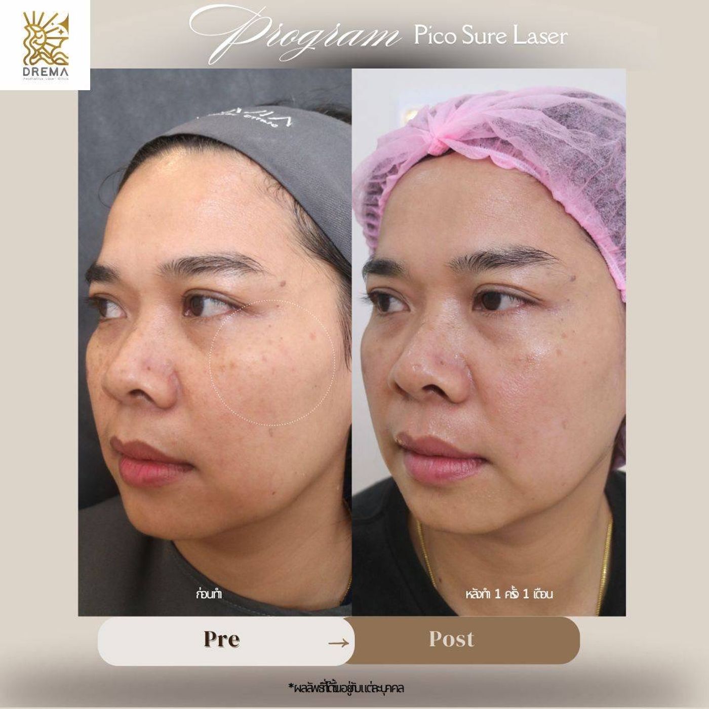 รูปรีวิว Pico Drema Clinic เคสที่ 30
