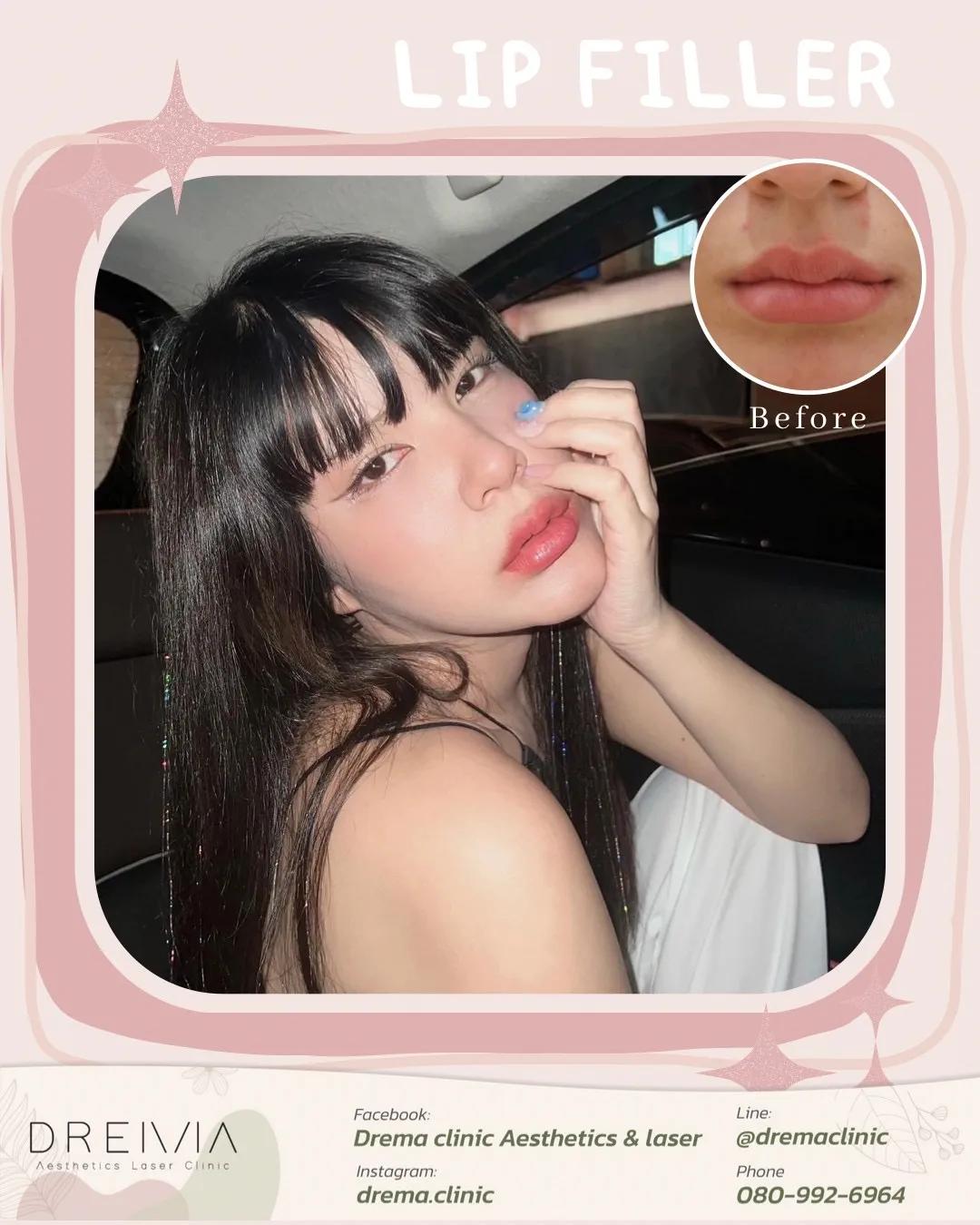 รีวิว Filler ปาก 21