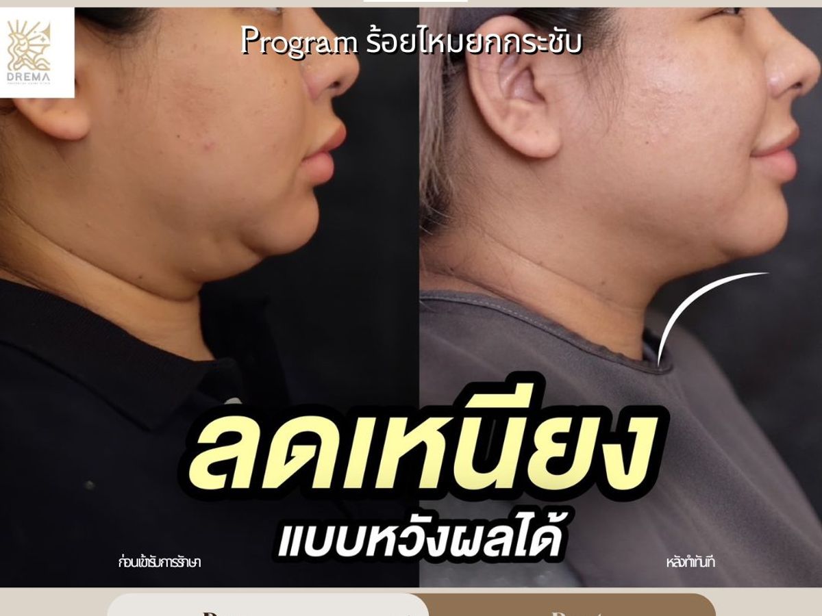 รีวิวร้อยไหม Drema Clinic