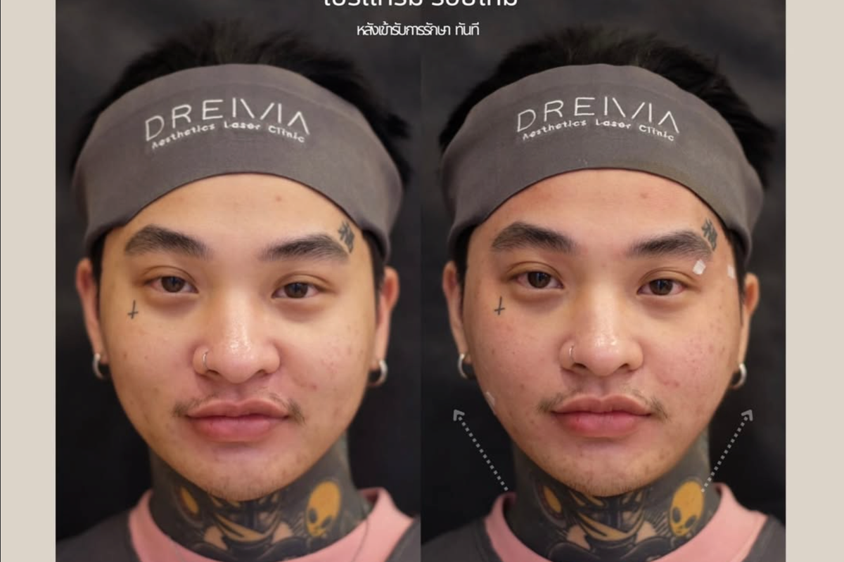 รีวิวร้อยไหม