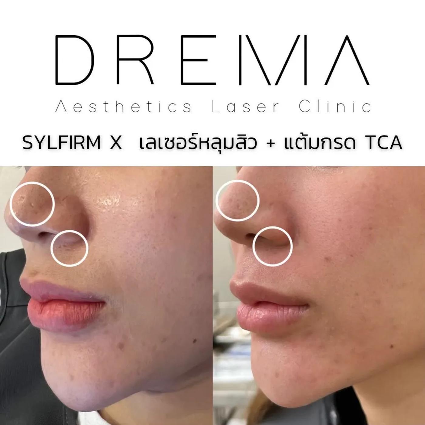 รีวิว SYLFIRM X 25
