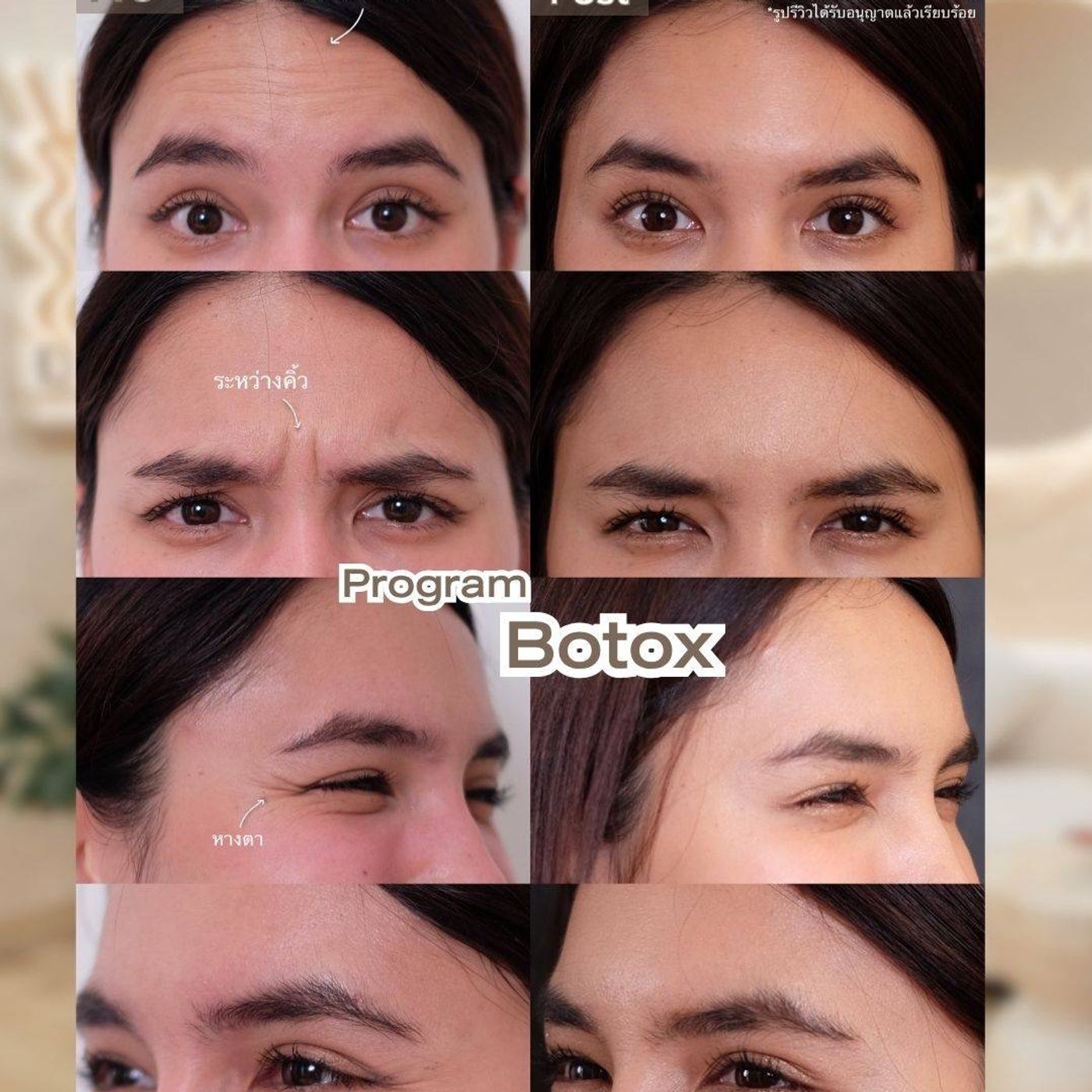 รูปรีวิว Botox Drema Clinic เคสที่ 1