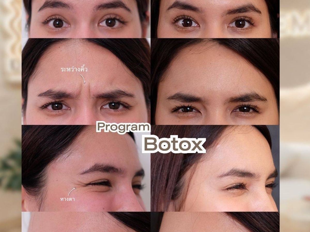 รูปรีวิว Botox Drema Clinic เคสที่ 1