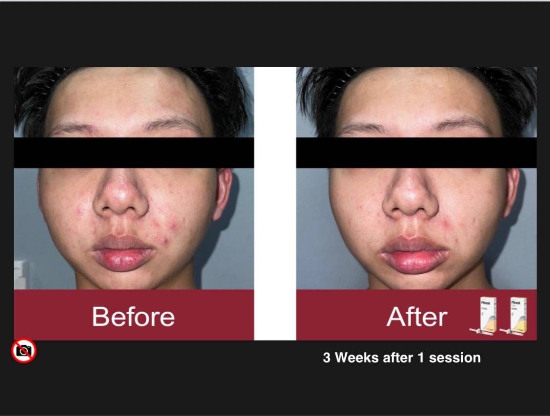 รูปรีวิว Skin Booster Drema Clinic เคสที่ 16