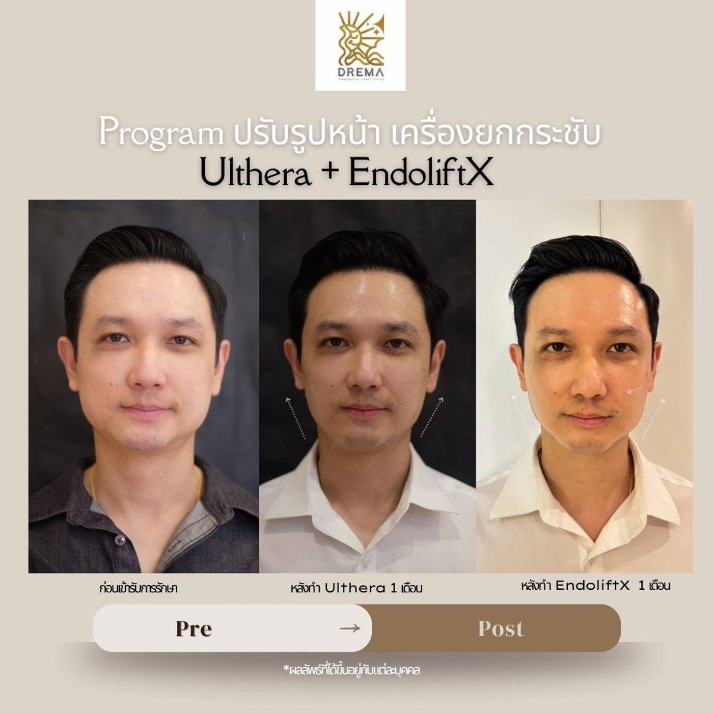 รูปรีวิว Endolift Drema Clinic เคสที่ 5