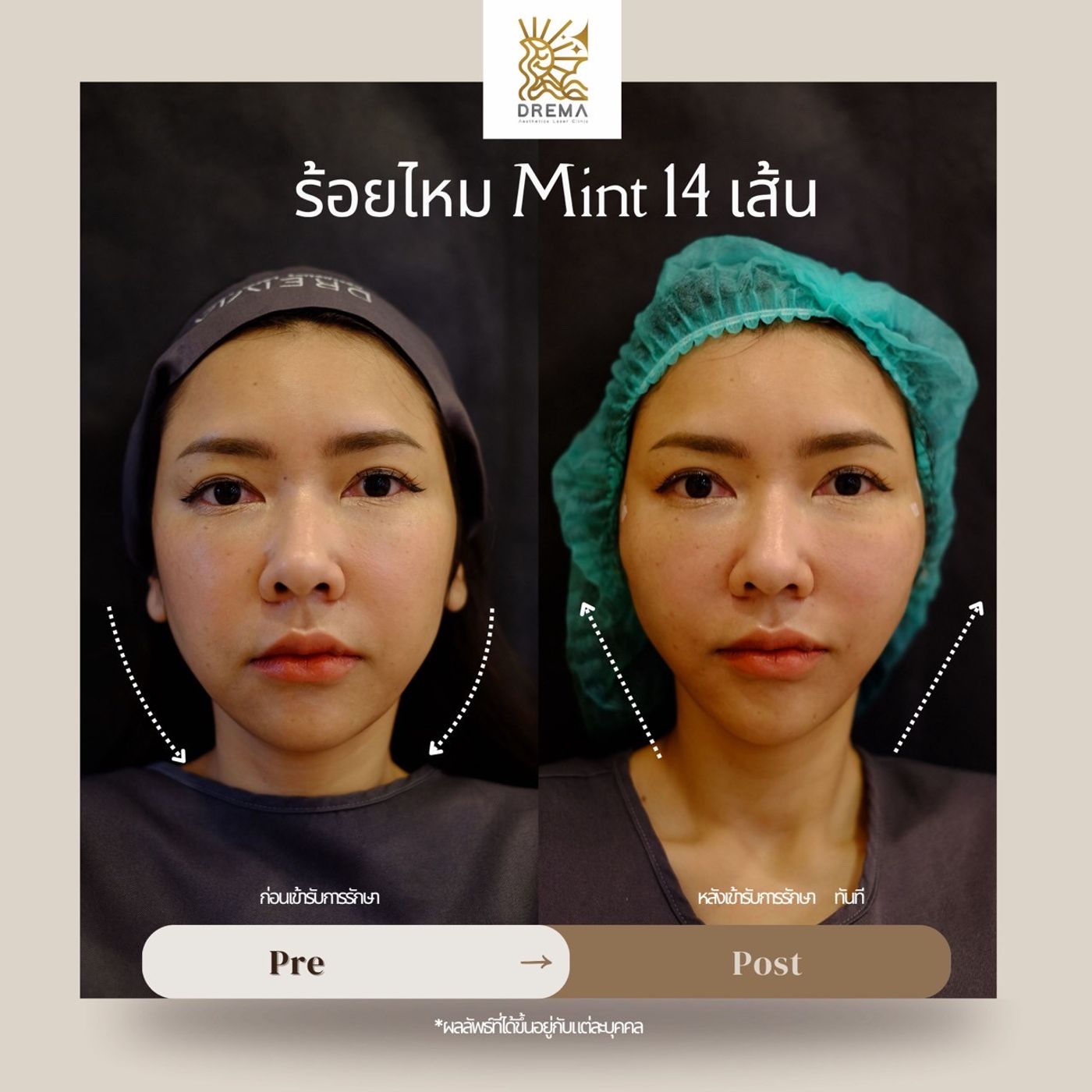 รูปรีวิว ร้อยไหม Drema Clinic เคสที่ 33