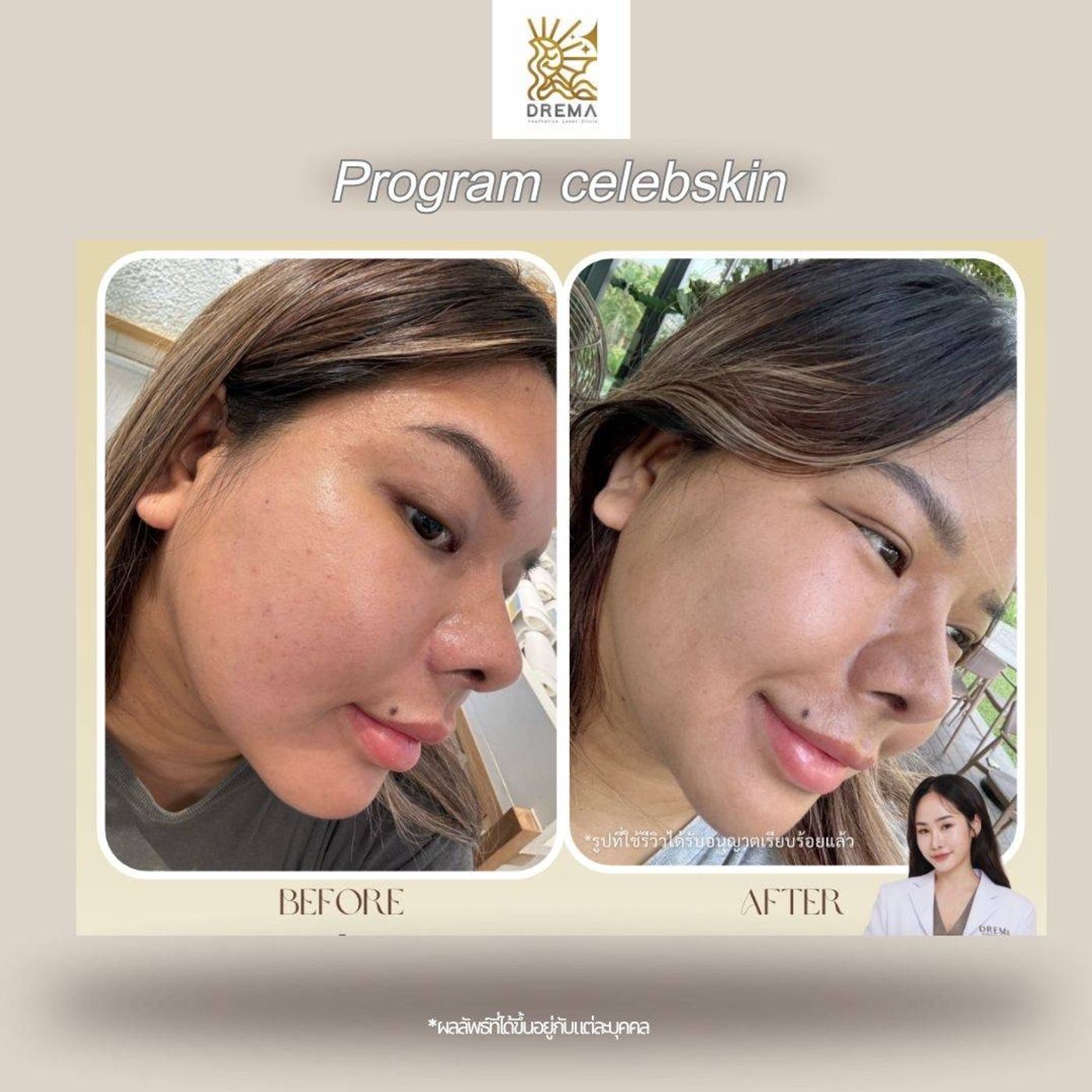 รูปรีวิว Skin Booster Drema Clinic เคสที่ 3