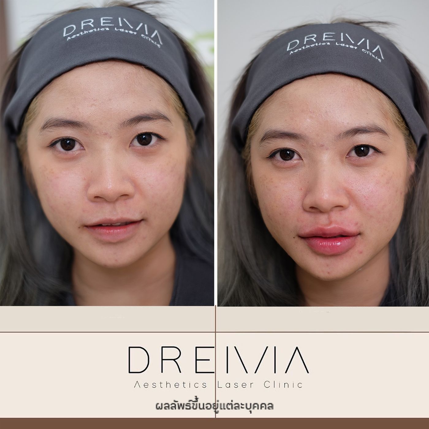 รีวิว Filler ปาก 46