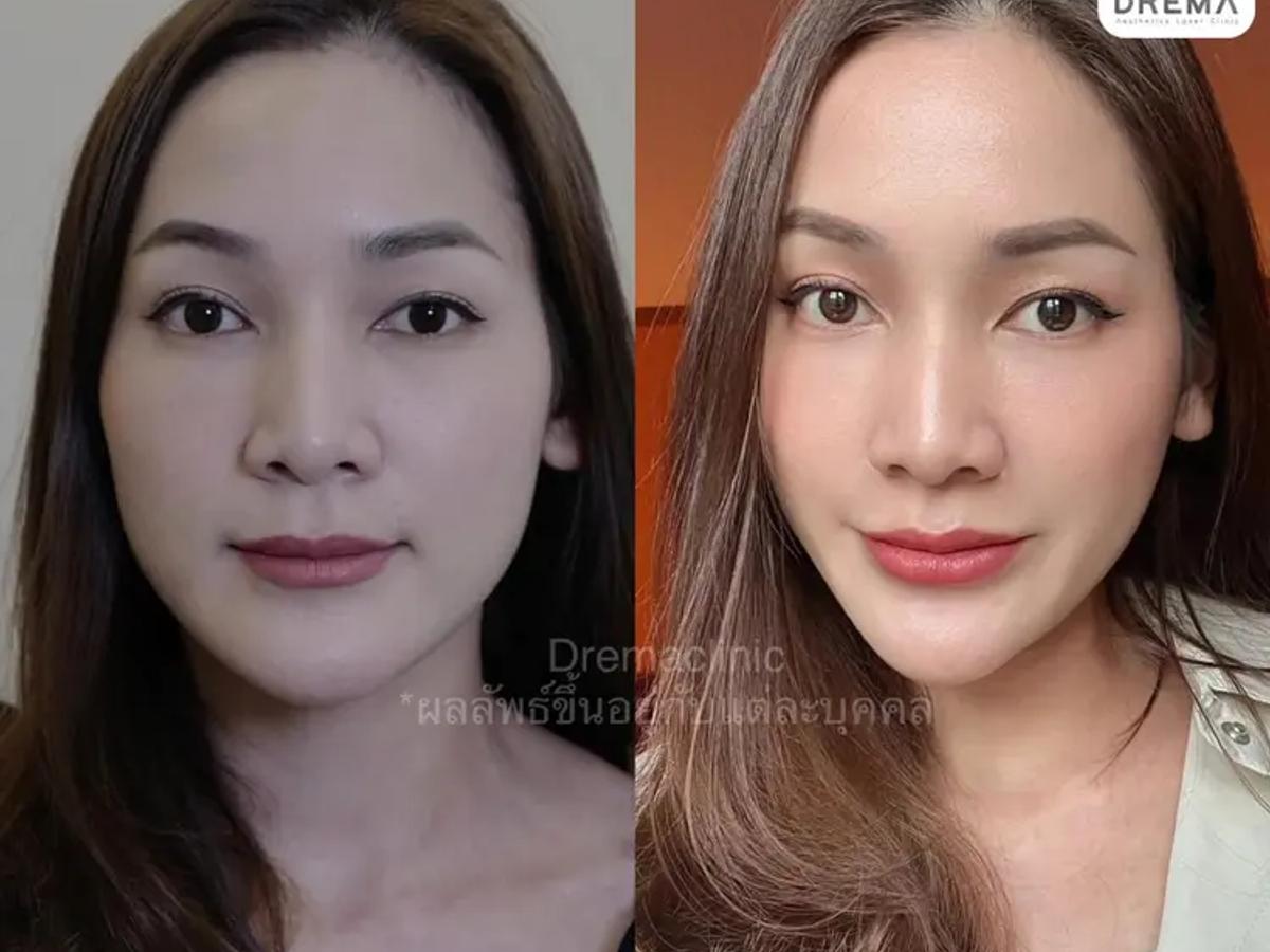 รีวิวการปรับรูปหน้า