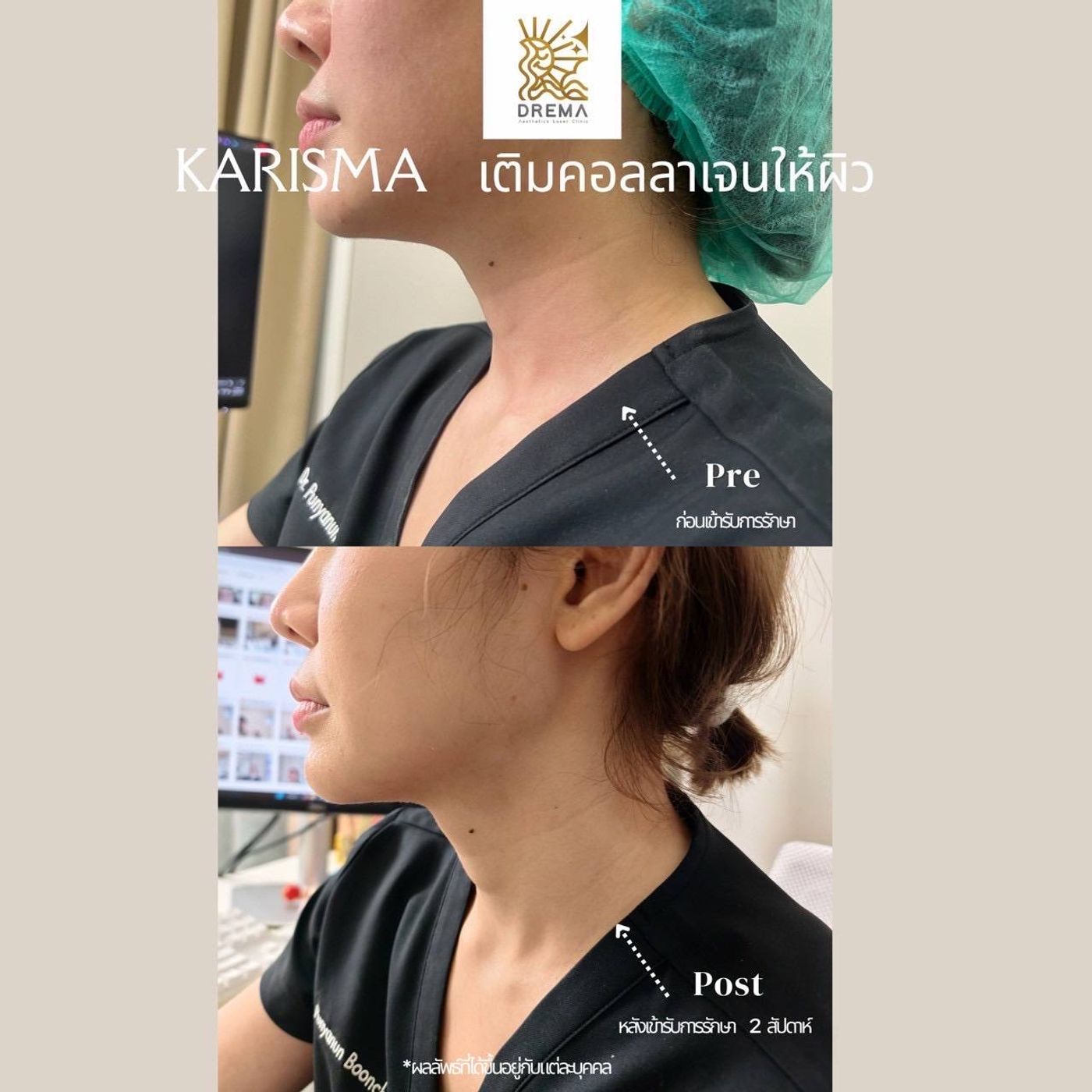 รูปรีวิว Skin Booster Drema Clinic เคสที่ 14