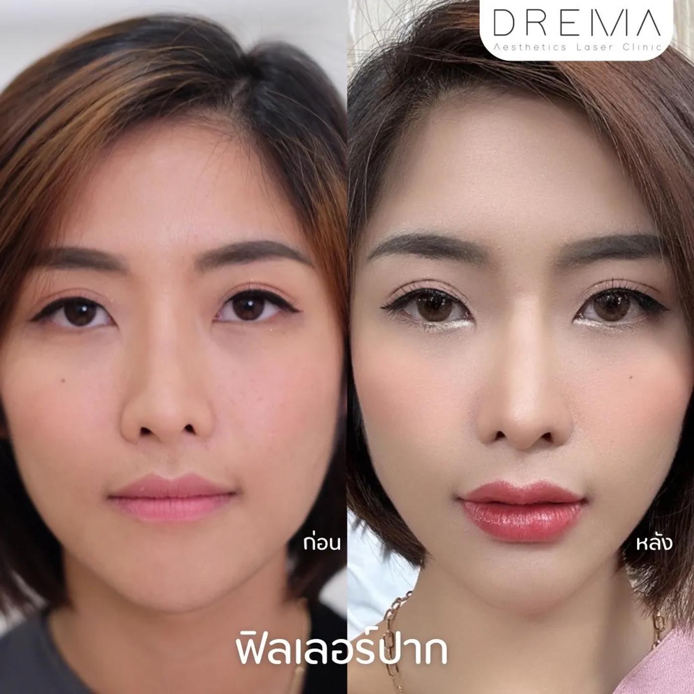 รีวิว Filler ปาก 9