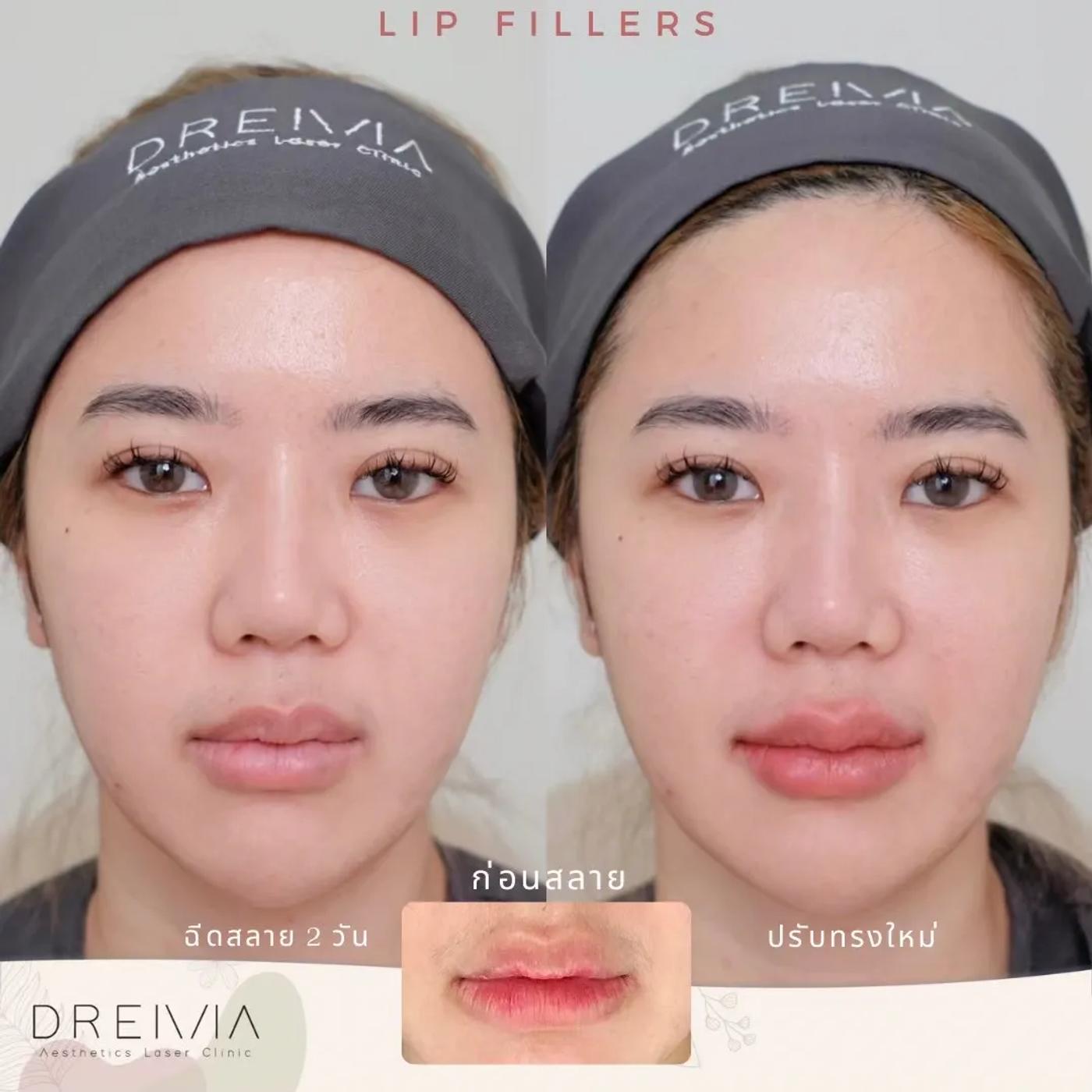 รีวิว Filler ปาก 28