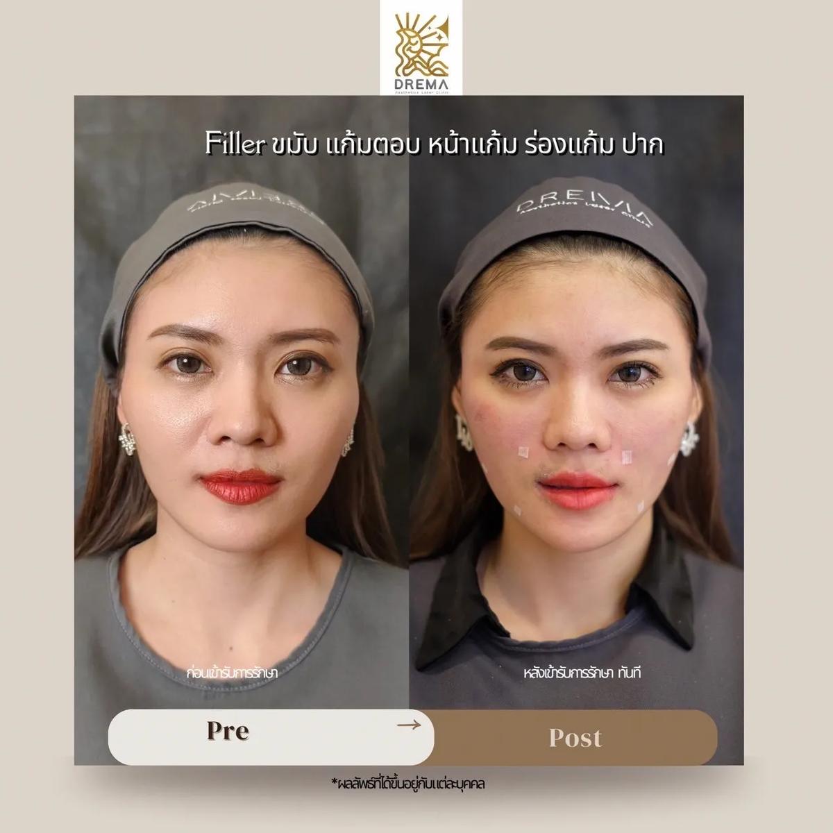 sunken-cheek-filler - Drema Clinic
