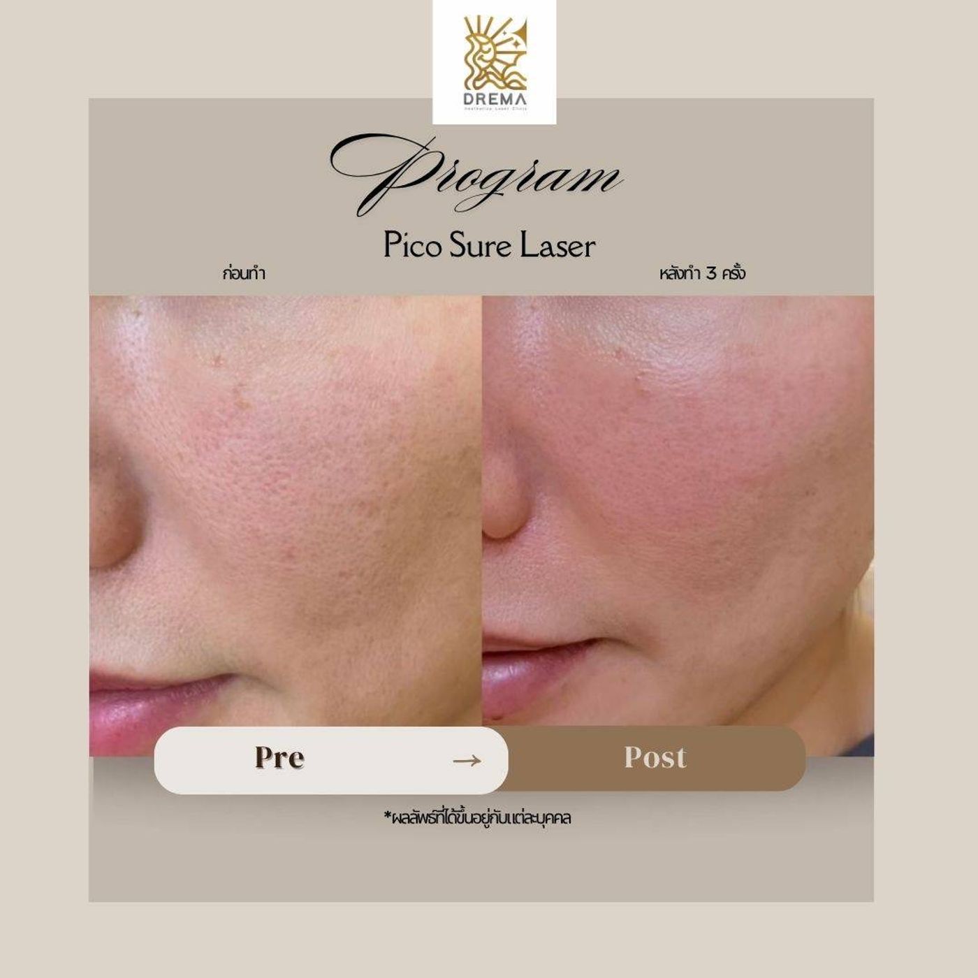 รูปรีวิว Pico Drema Clinic เคสที่ 19