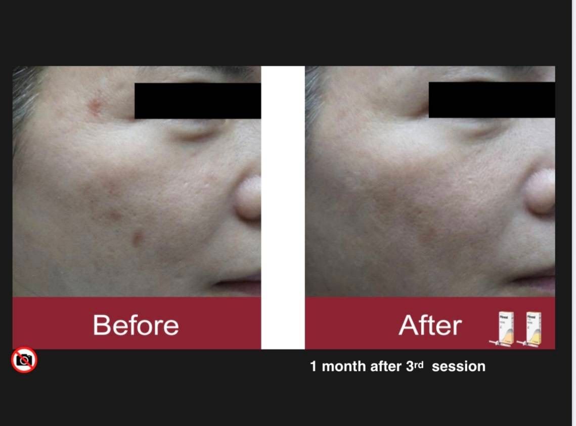 รูปรีวิว Skin Booster Drema Clinic เคสที่ 18