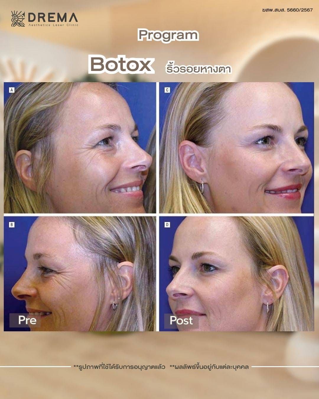 รูปรีวิว Botox Drema Clinic เคสที่ 3