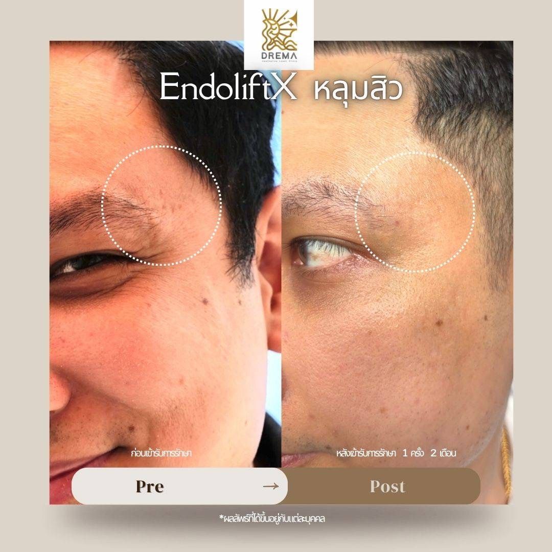 รีวิว Endolift Drema Clinic