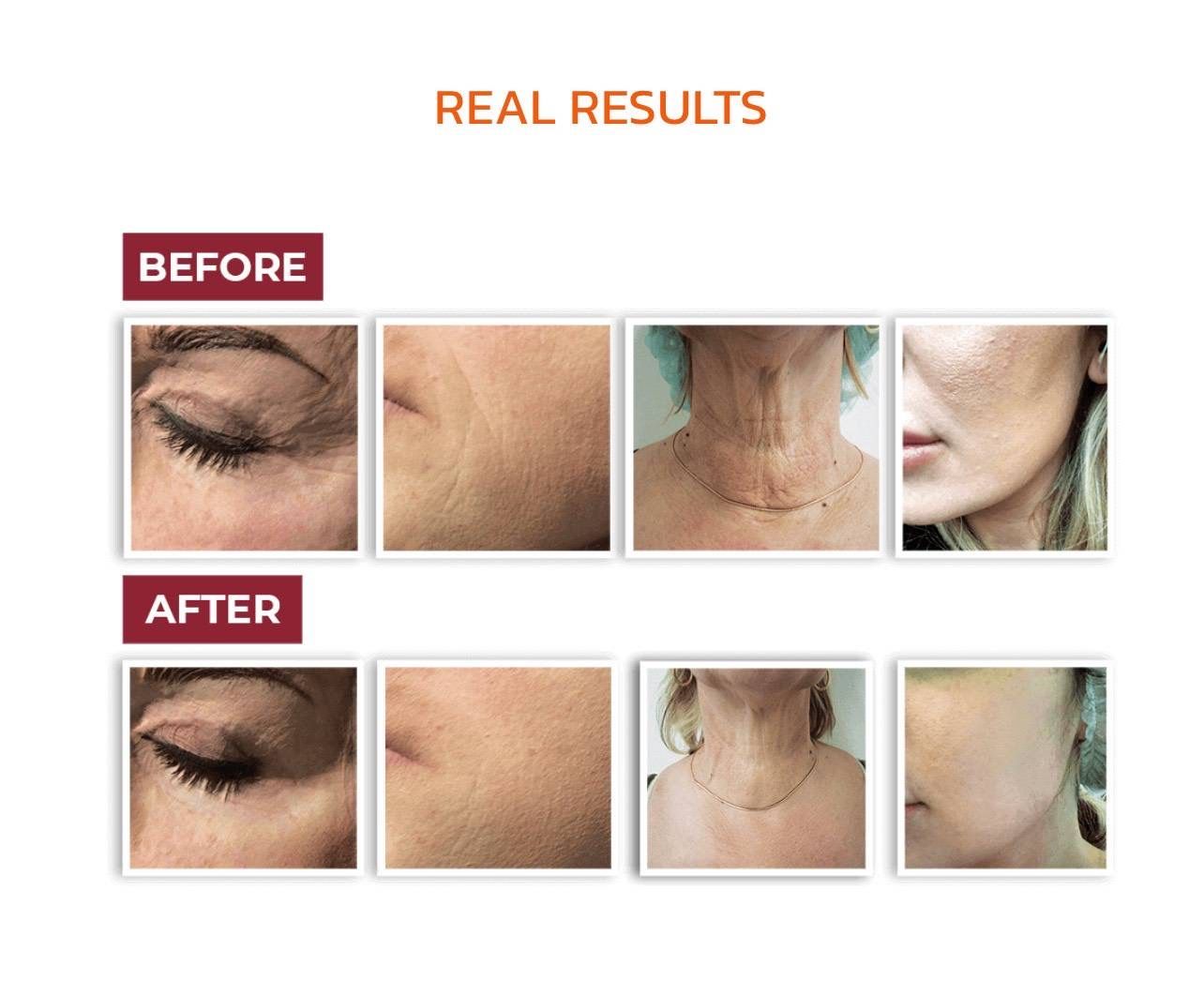 รูปรีวิว Skin Booster Drema Clinic เคสที่ 21