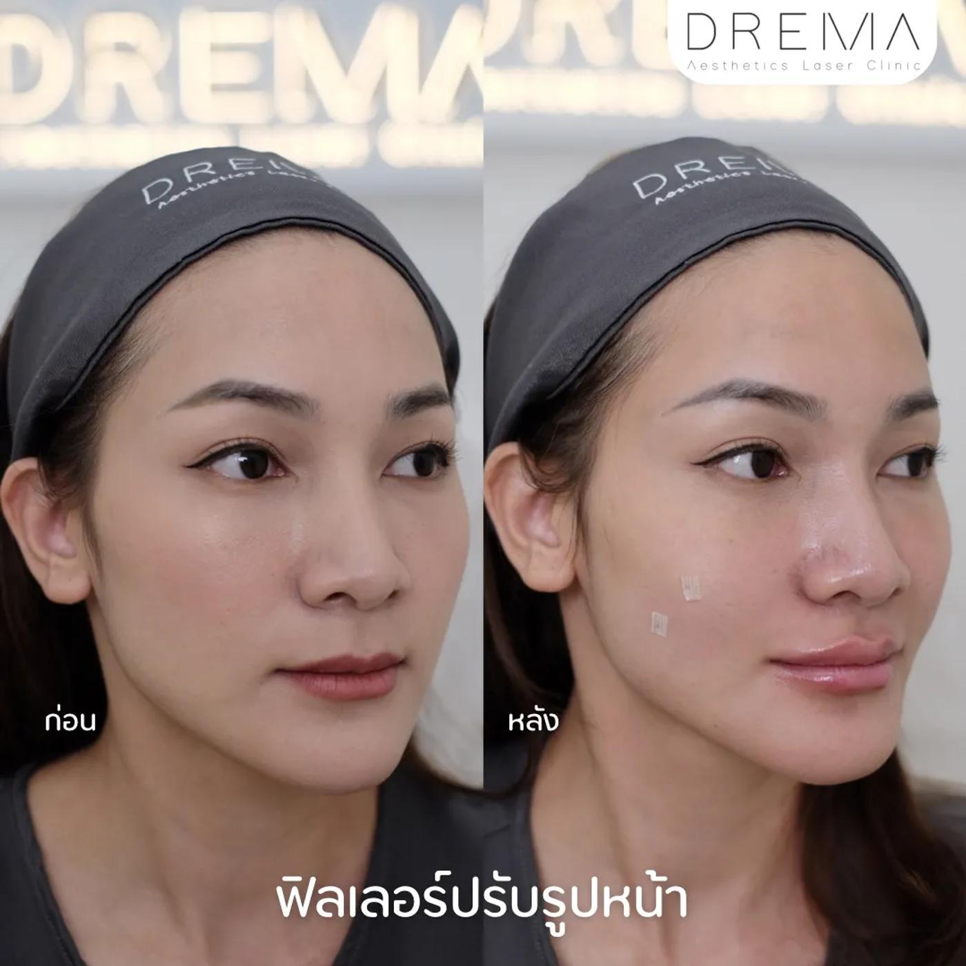 รีวิวการปรับรูปหน้า 5