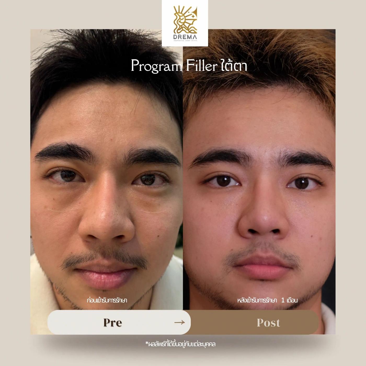 รีวิวฟิลเลอร์ใต้ตา 6