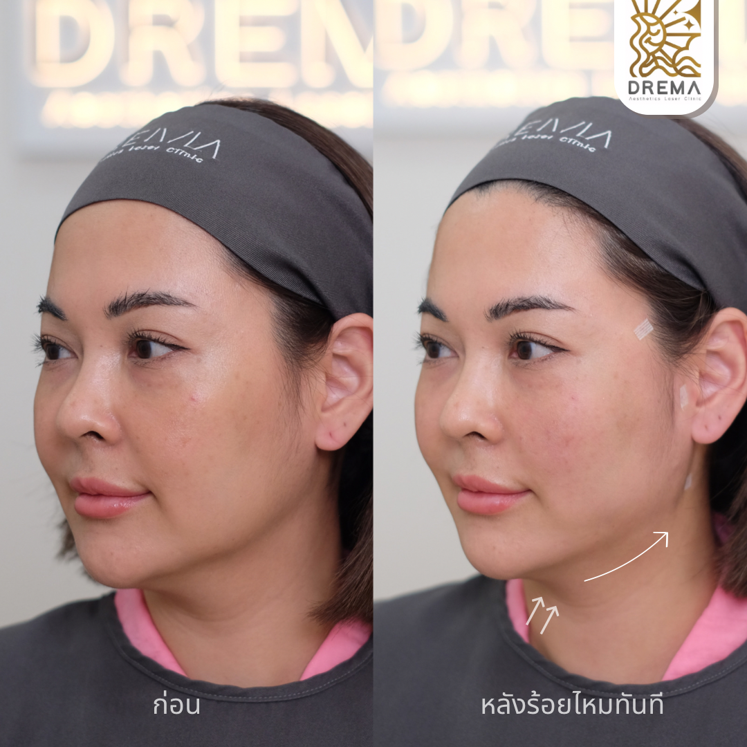 ร้อยไหมกรอบหน้า