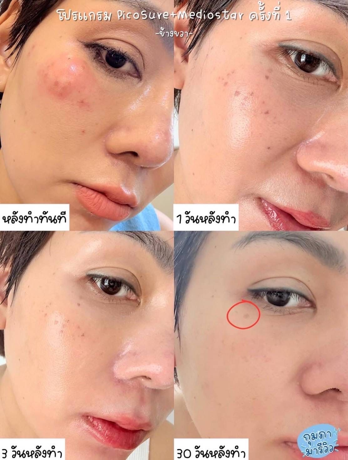 รูปรีวิว Pico Drema Clinic เคสที่ 18